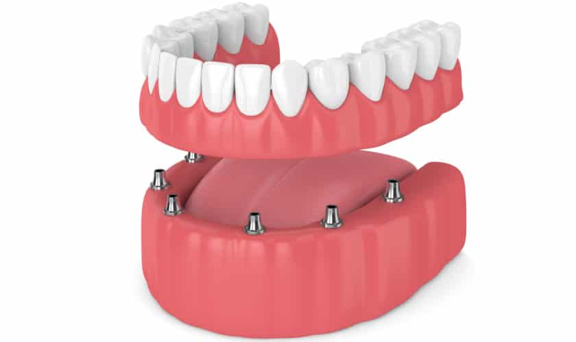 implant overdentures