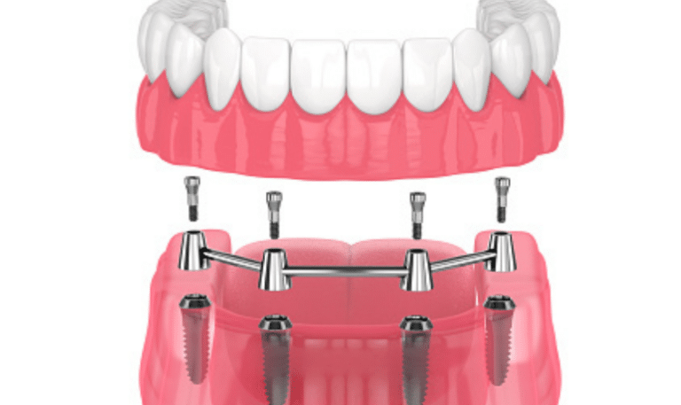 Know In Detail About Dental Implant Supported Bridge