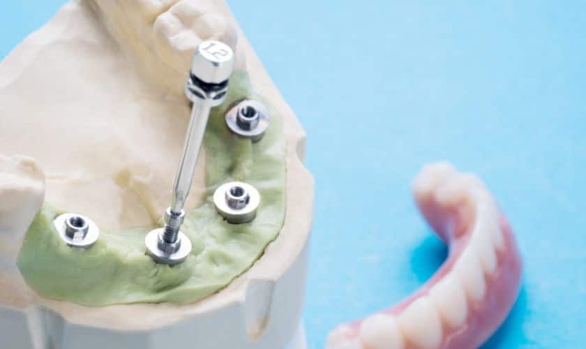 Implant Overdenture Lubbock