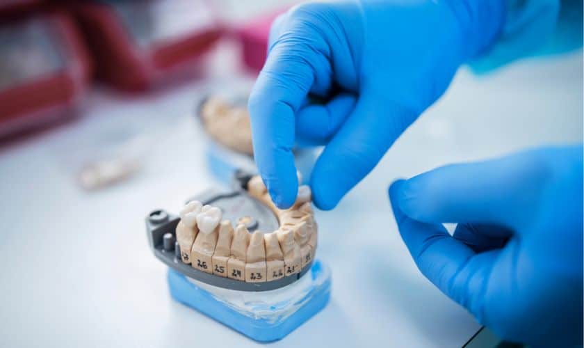 Implant-Supported Bridges - Lubbock Dental Implant Center
