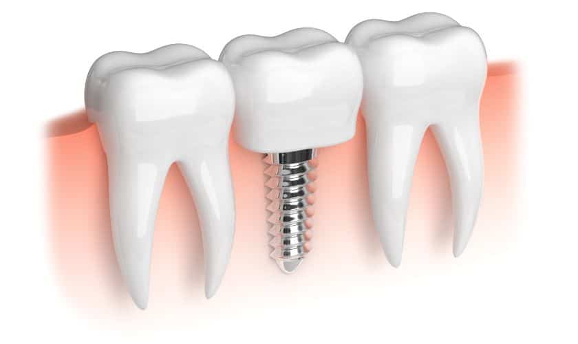 Dental Implants Lubbock