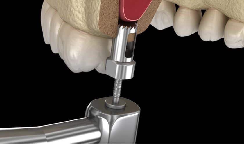 Sinus Lift Technique in Lubbock