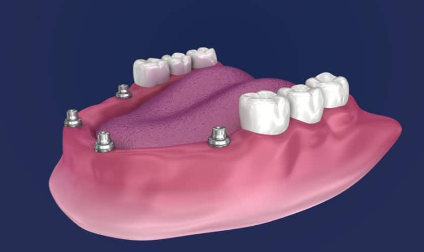 Implant-Overdentures-Require-Special-Care