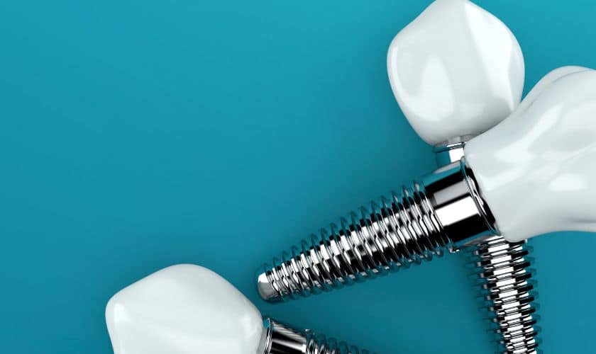 dental implants for multiple teeth