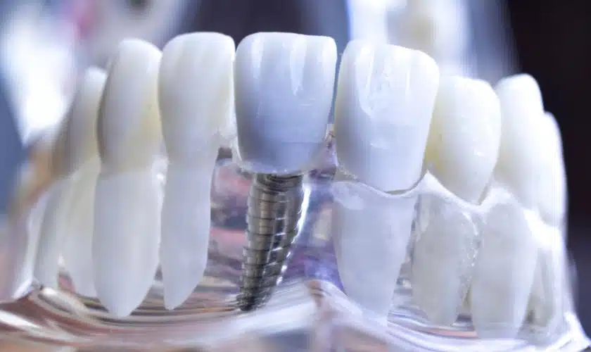 same day dental implants