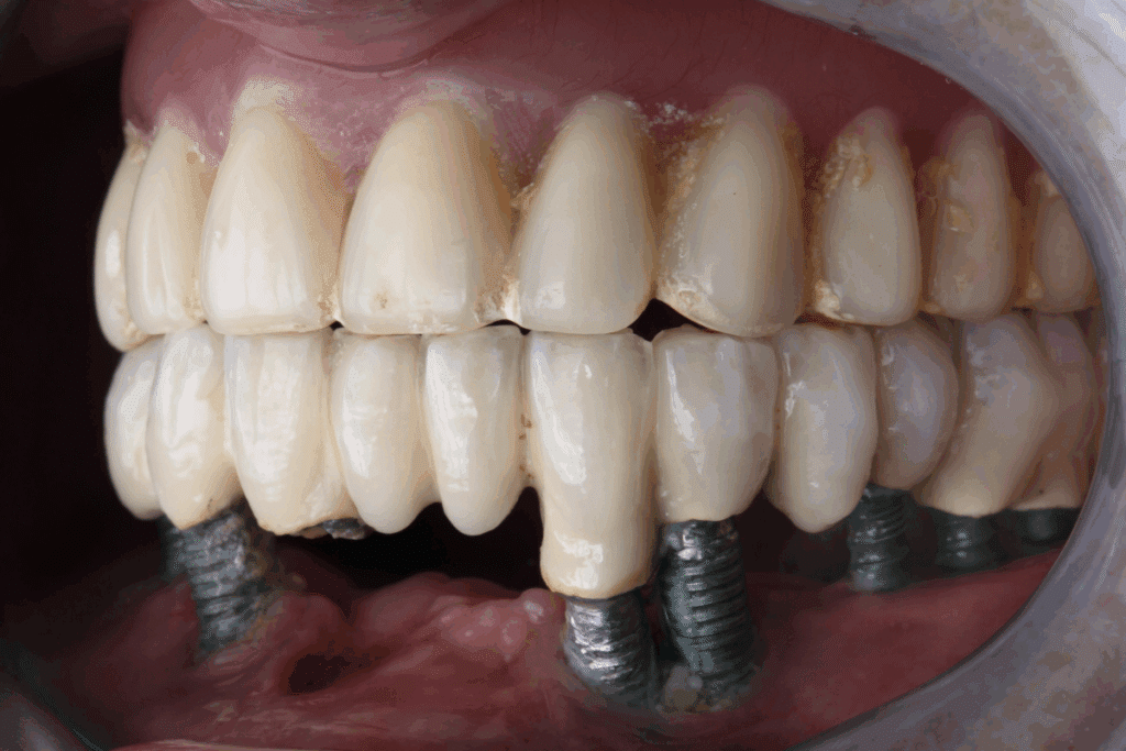 Single Tooth vs. Full Arch Dental Implants A Guide to Choosing the Right Solution
