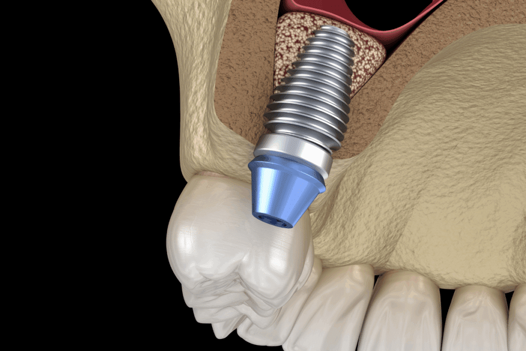Sinus Lift for Dental Implants: Building a Strong Foundation for Your Smile