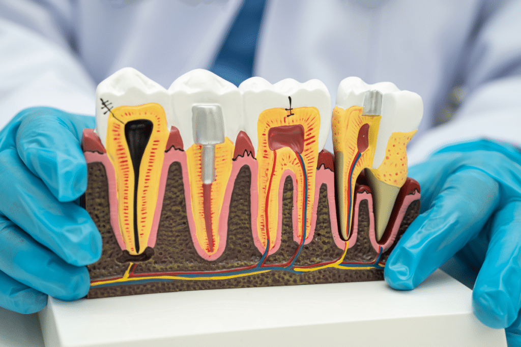 dental implants