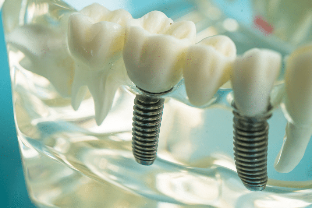 dental implants