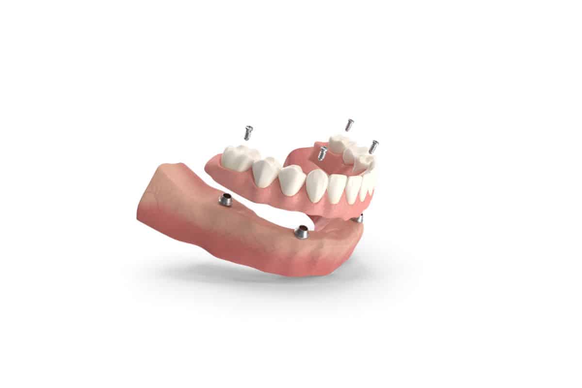 An implant-supported denture model demonstrates how dental implants can securely anchor a full-arch tooth replacement.
